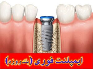 ایمپلنت فوری دندان (کاشت دندان در یک روز) | قیمت ایمپلنت فوری