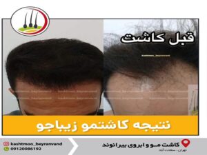 با توجه به شرایط من، کدام تکنیک کاشت مو مناسب است؟