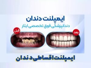 ایمپلنت اقساطی؛ کاشت ایمپلنت به صورت قسطی چگونه است؟
